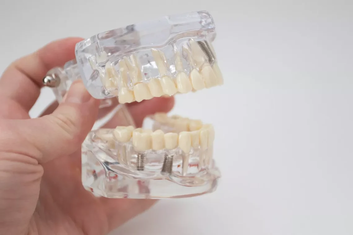 Miniimplanty – czym się różnią od klasycznych implantów?