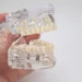 Miniimplanty – czym się różnią od klasycznych implantów?